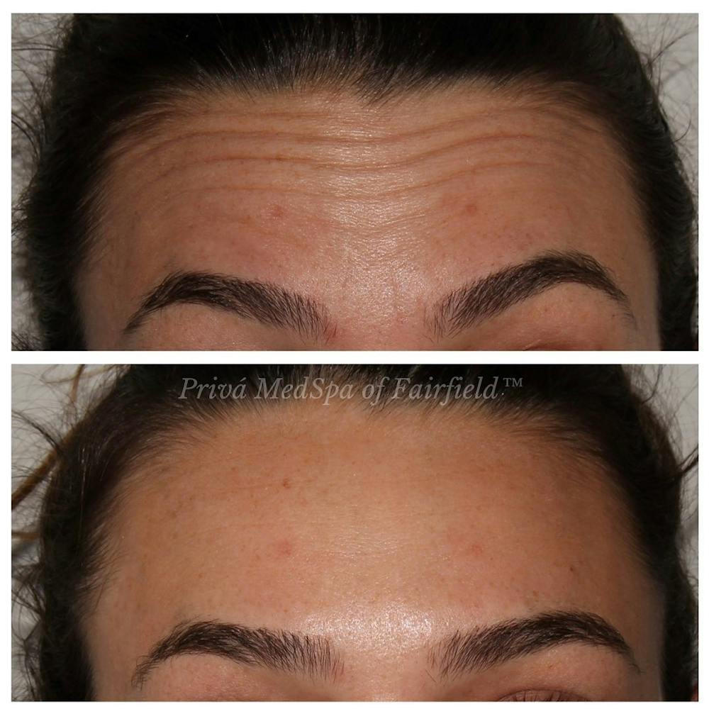 Botox/Dysport/Jeuveau Before & After Gallery - Patient 141066756 - Image 1