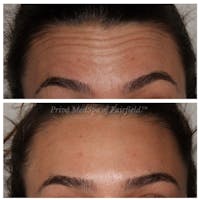 Botox/Dysport/Jeuveau Before & After Gallery - Patient 141066756 - Image 1