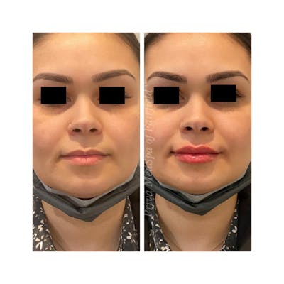 Restylane Before & After Gallery - Patient 142762753 - Image 1