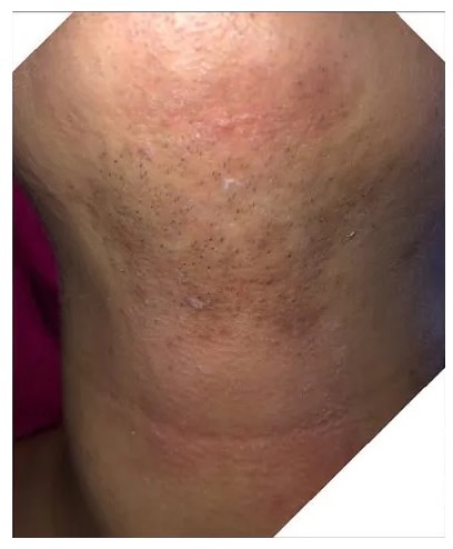 Before and After Laser Hair Removal in Fairfield