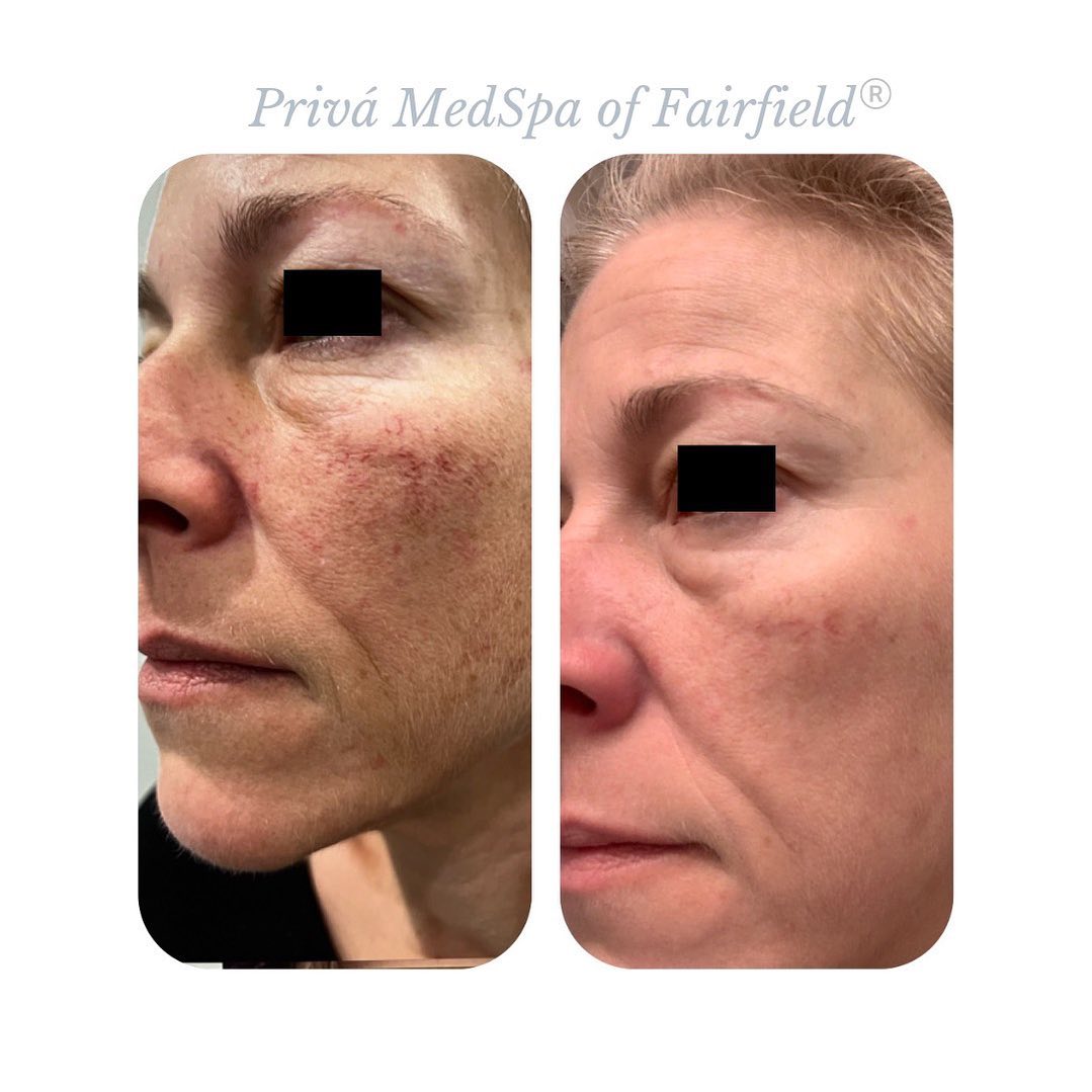 Before and After IPL Photofacial in Westport