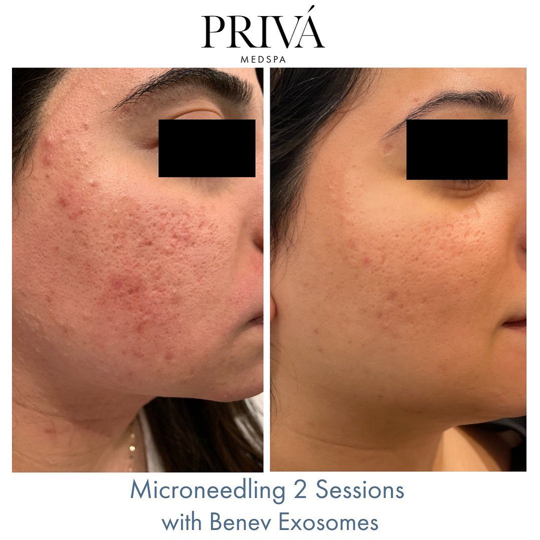 Before and After Microneedling in Westport