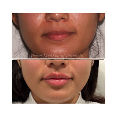 Lip Augmentation Before & After Gallery - Patient 176832807 - Image 1