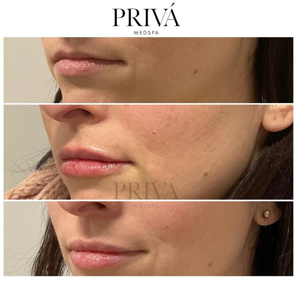 Lip Augmentation Before & After Gallery - Patient 227437 - Image 1