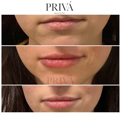 Lip Augmentation Before & After Gallery - Patient 227437 - Image 2