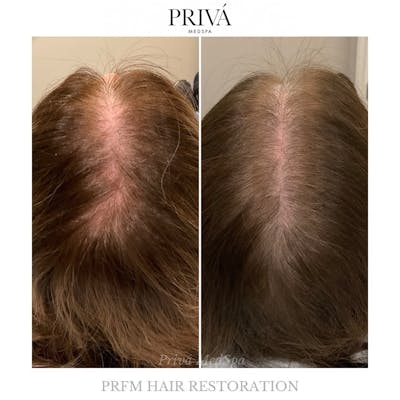 Hair Restoration  Before & After Gallery - Patient 365618 - Image 1