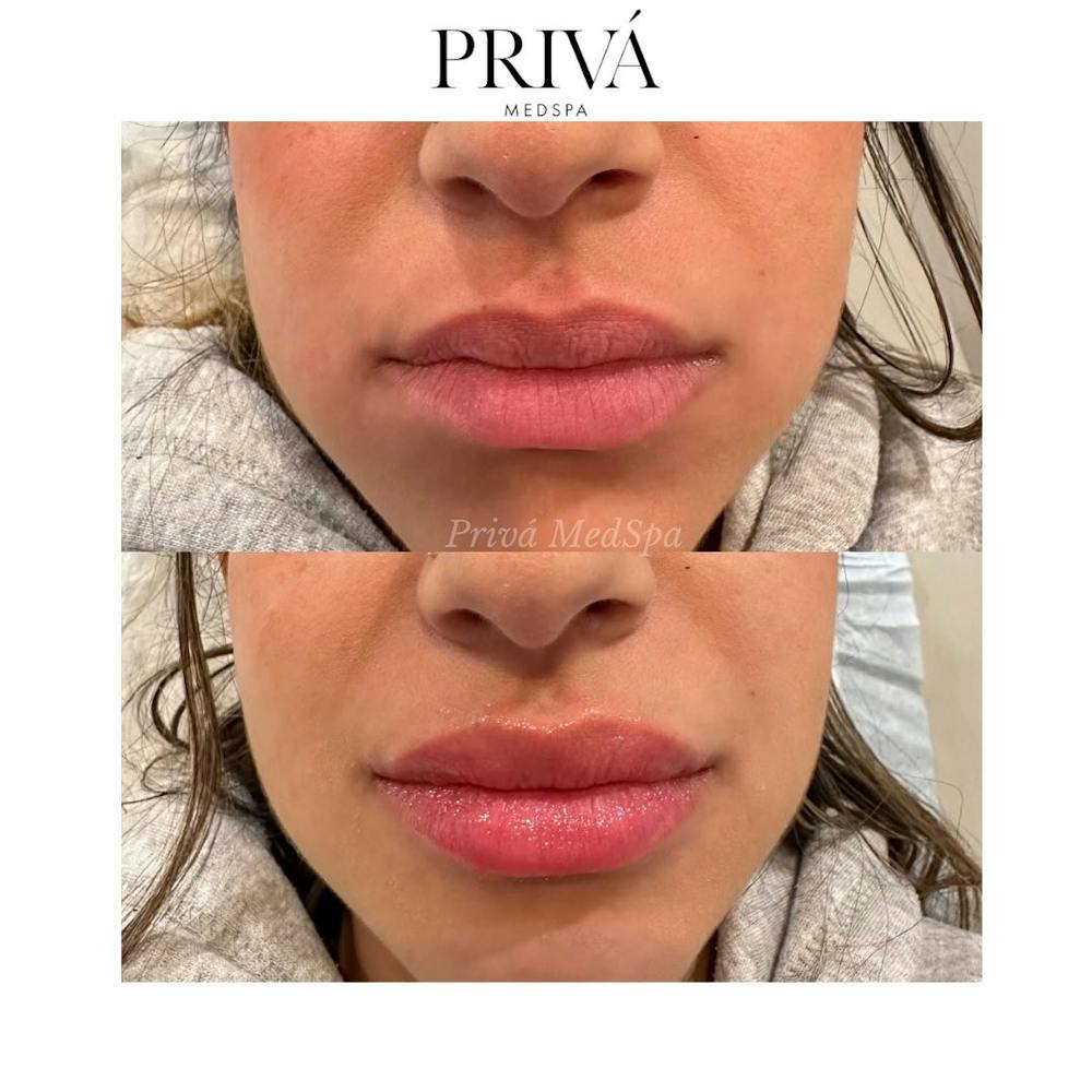 Lip Augmentation Before & After Gallery - Patient 410258 - Image 1