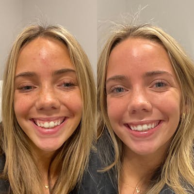 Gummy Smile Treatment Before & After Gallery - Patient 285319 - Image 1