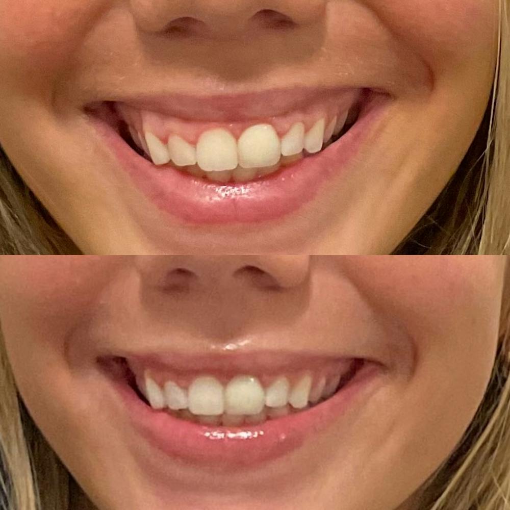 Gummy Smile Treatment Before & After Gallery - Patient 285319 - Image 2