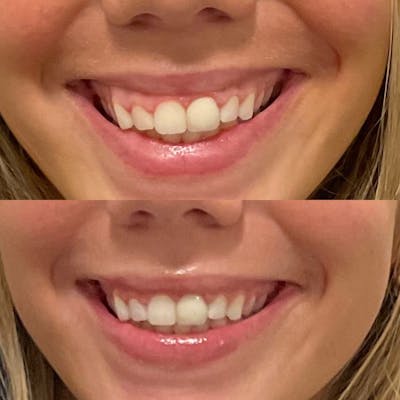 Gummy Smile Treatment Before & After Gallery - Patient 285319 - Image 2