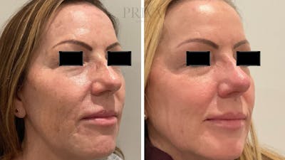 Laser Resurfacing Before & After Gallery - Patient 348766 - Image 2