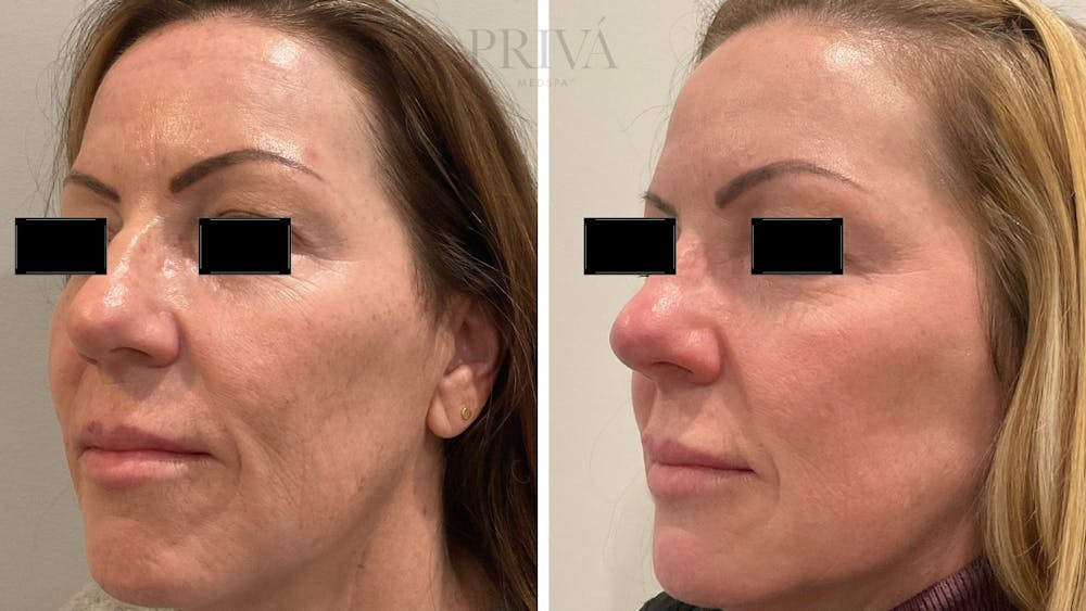 Laser Resurfacing Before & After Gallery - Patient 348766 - Image 3