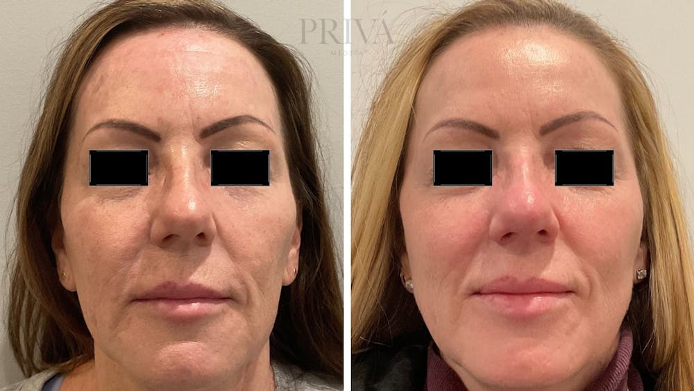 Laser Resurfacing Before & After Gallery - Patient 348766 - Image 1