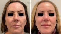 Laser Resurfacing Before & After Gallery - Patient 348766 - Image 1