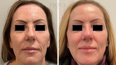 Laser Resurfacing Before & After Gallery - Patient 348766 - Image 1