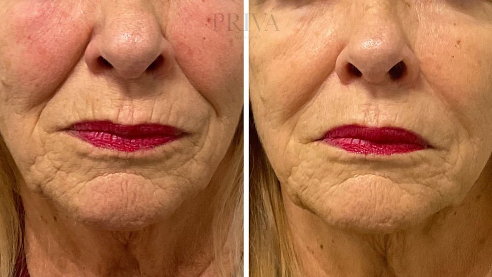 Botox/Dysport/Jeuveau Before & After Gallery - Patient 218385 - Image 1