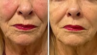 Botox/Dysport/Jeuveau Before & After Gallery - Patient 218385 - Image 1