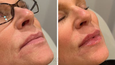 Lip Augmentation Before & After Gallery - Patient 766350 - Image 1