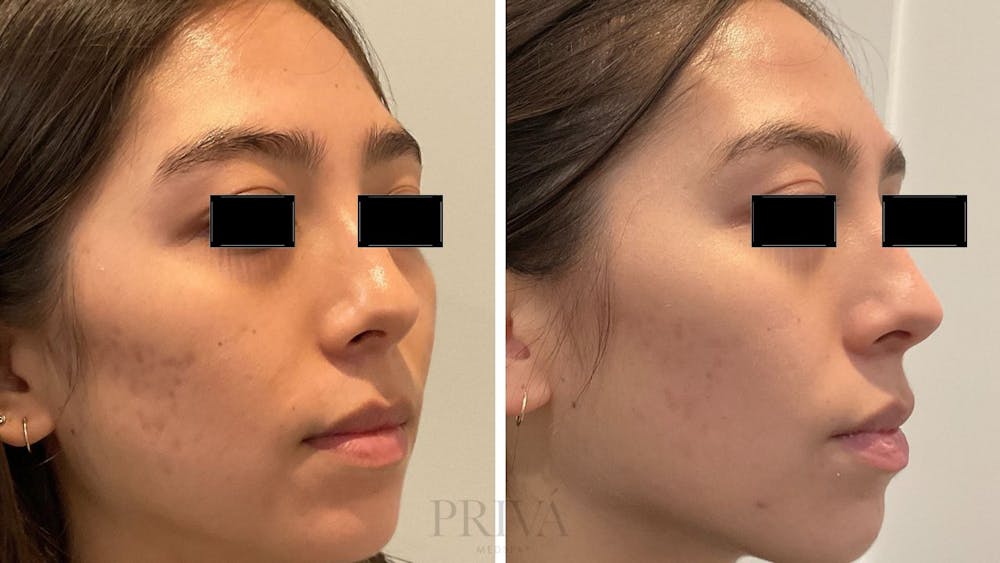 Microneedling  Before & After Gallery - Patient 203020 - Image 1