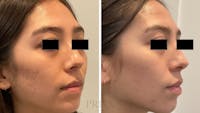 Microneedling  Before & After Gallery - Patient 203020 - Image 1