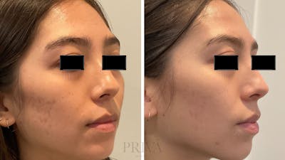 Microneedling  Before & After Gallery - Patient 203020 - Image 1