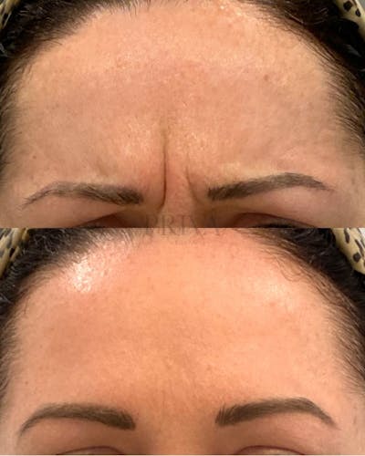 Botox/Dysport/Jeuveau Before & After Gallery - Patient 416893 - Image 1