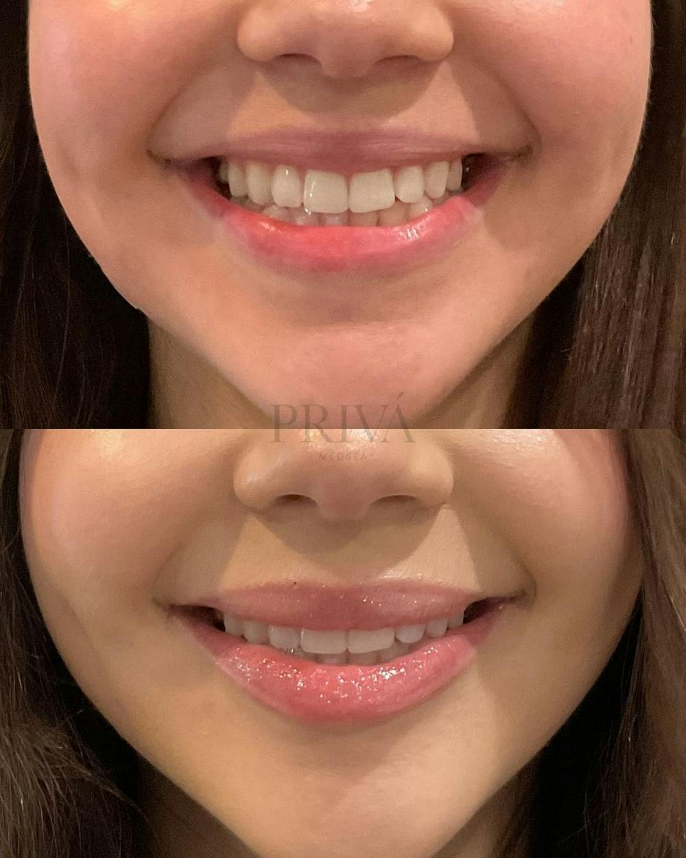 Botox/Dysport/Jeuveau Before & After Gallery - Patient 102250 - Image 1