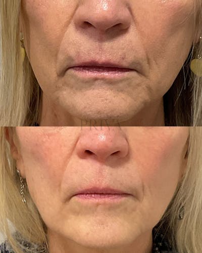 Botox/Dysport/Jeuveau Before & After Gallery - Patient 156141 - Image 1