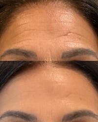 Botox/Dysport/Jeuveau Before & After Gallery - Patient 407162 - Image 1