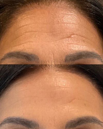 Botox/Dysport/Jeuveau Before & After Gallery - Patient 407162 - Image 1