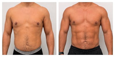 Hormone Replacement Therapy Before & After Gallery - Patient 348426 - Image 1