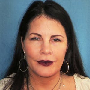 Brow Lift