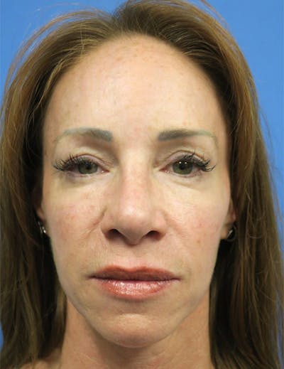 Cheek Implant Before & After Gallery - Patient 4751914 - Image 1