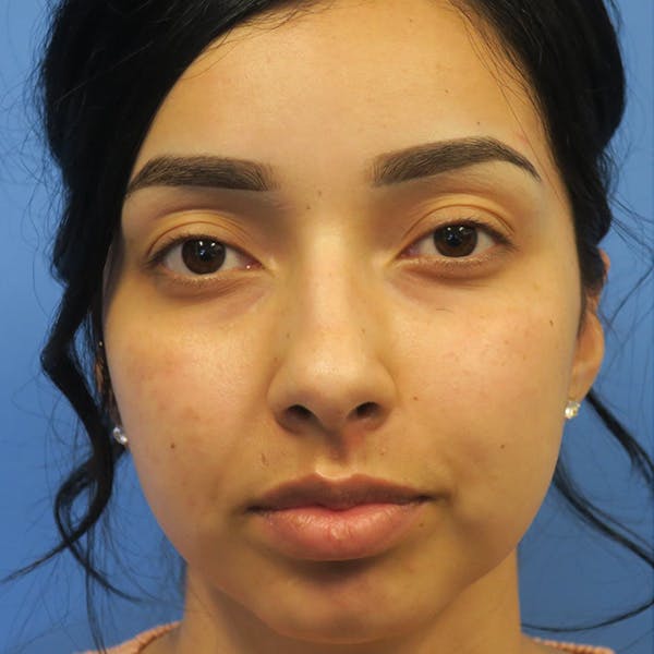 Buccal Fat Removal Before & After Gallery - Patient 4751921 - Image 1