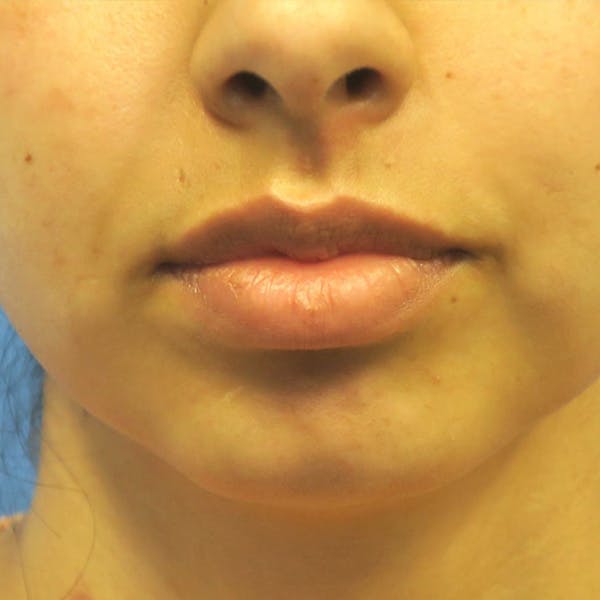 Buccal Fat Removal Before & After Gallery - Patient 4751921 - Image 3