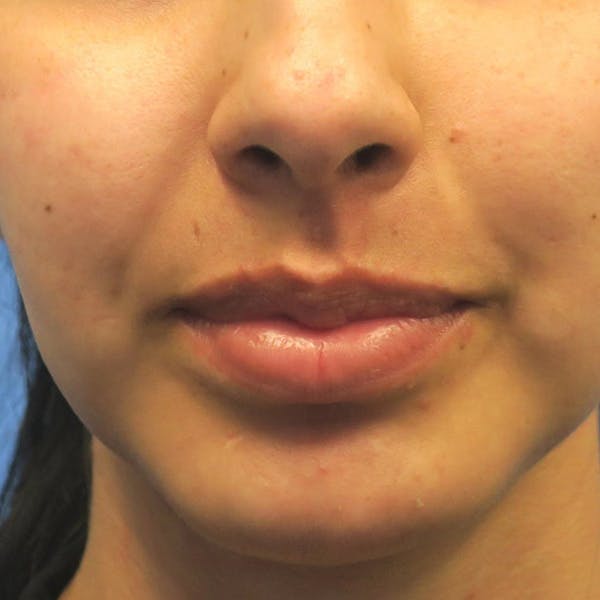 Buccal Fat Removal Before & After Gallery - Patient 4751921 - Image 4