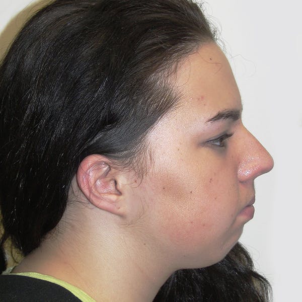 Chin Surgery Gallery - Patient 4751930 - Image 1