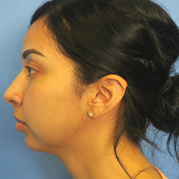 Chin Surgery Before & After Gallery - Patient 4751934 - Image 1