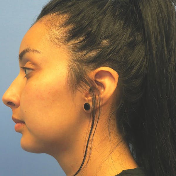 Chin Surgery Before & After Gallery - Patient 4751934 - Image 2