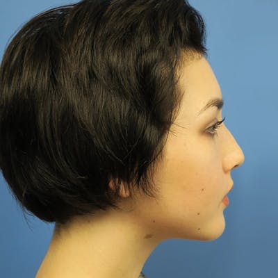 Chin Surgery Before & After Gallery - Patient 4751939 - Image 2