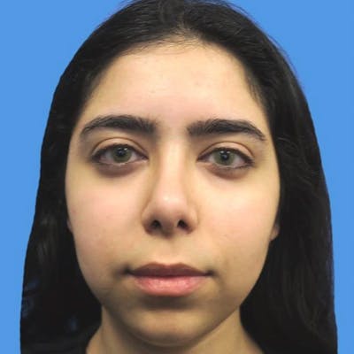 Chin Surgery Before & After Gallery - Patient 4751940 - Image 1