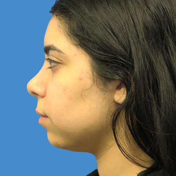 Chin Surgery Before & After Gallery - Patient 4751940 - Image 3