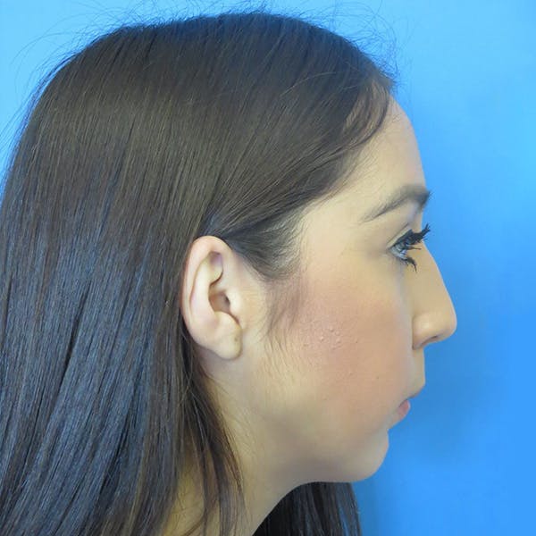 Chin Surgery Before & After Gallery - Patient 4751941 - Image 1