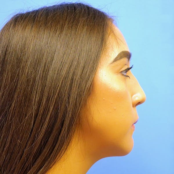 Chin Surgery Before & After Gallery - Patient 4751941 - Image 2