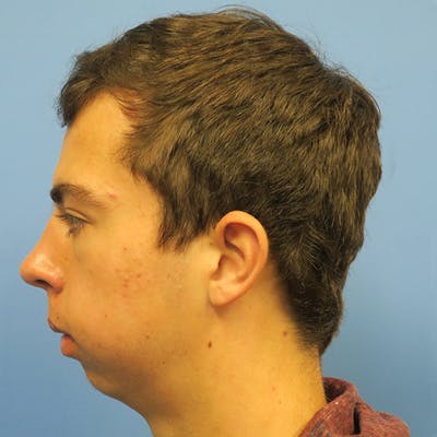 Chin Surgery Before & After Gallery - Patient 4751942 - Image 1