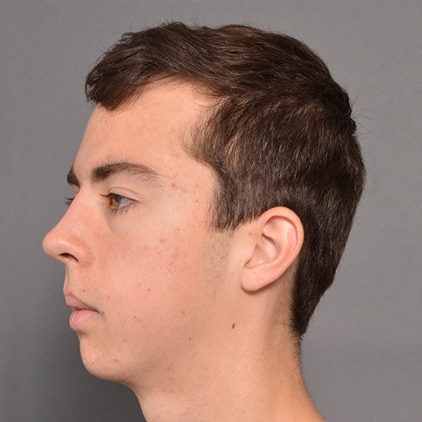 Chin Surgery Before & After Gallery - Patient 4751942 - Image 2