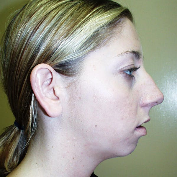 Chin Surgery Before & After Gallery - Patient 4751945 - Image 1