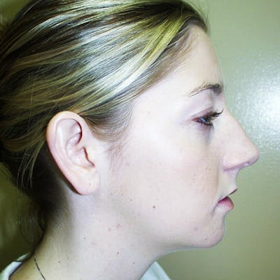 Chin Surgery Before & After Gallery - Patient 4751945 - Image 2