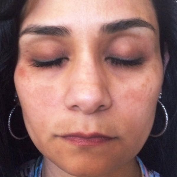 Cosmelan Peel Before & After Gallery - Patient 4751953 - Image 1