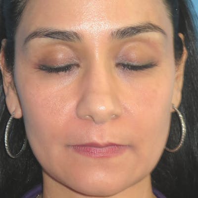 Cosmelan Peel Before & After Gallery - Patient 4751953 - Image 2